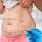 liposuction-image