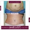 The effect of abdominoplasty on the beauty of the abdomen-image