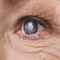 cataract surgery-image