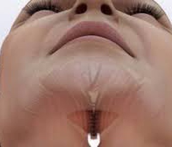 picture of Chin implant surgery