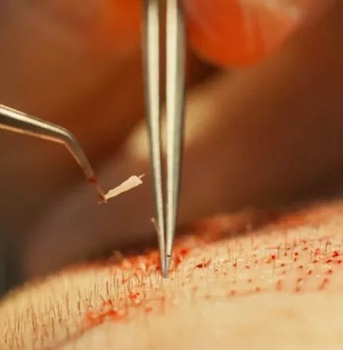  الصوره زراعة الشعر FUT