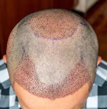  الصوره زراعة الشعر المختلط