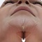 Chin implant surgery-image